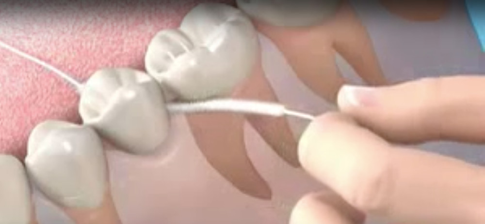 Καθαριστμός οδοντιατρικής γέφυρας με Superfloss